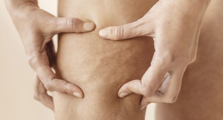 Zbliżenie na dłonie osoby ściskającej skórę na udzie, ukazujące cellulit.