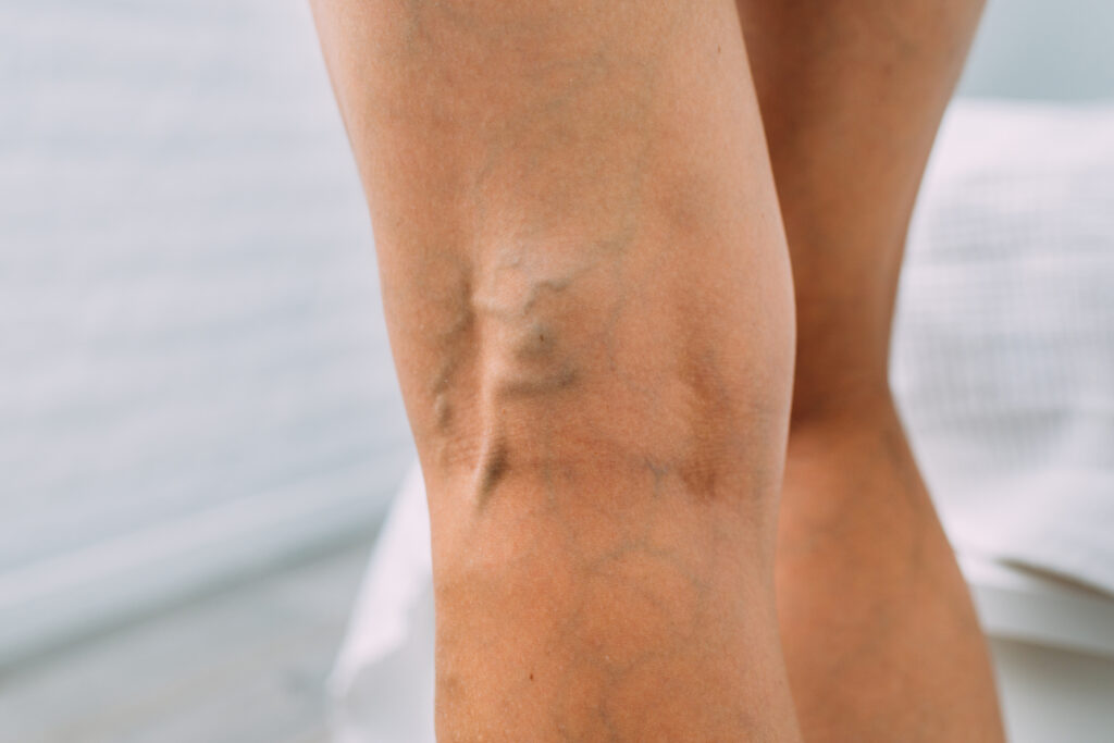 Varicose veins on a leg before treatment in Clapham