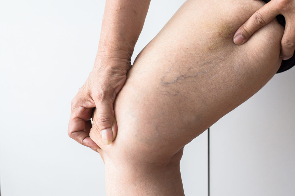Thread veins on a leg before treatment in Clapham